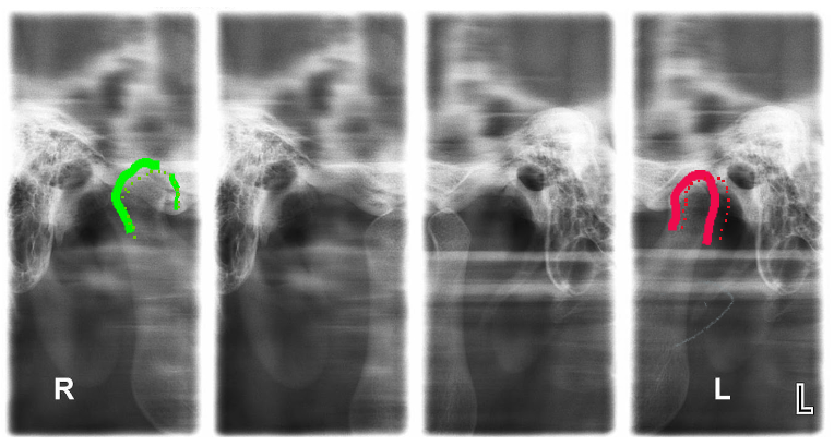 בתמונה המצורפת רואים הבדל בין מפרק אחד לשני (צבע אדום וירוק). צילום זה נדרש כחלק מאבחנה של בעיות במפרק הלסת.
