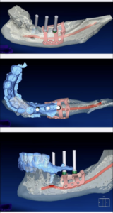 שתל חדשני – PSI – Patient specific implant 